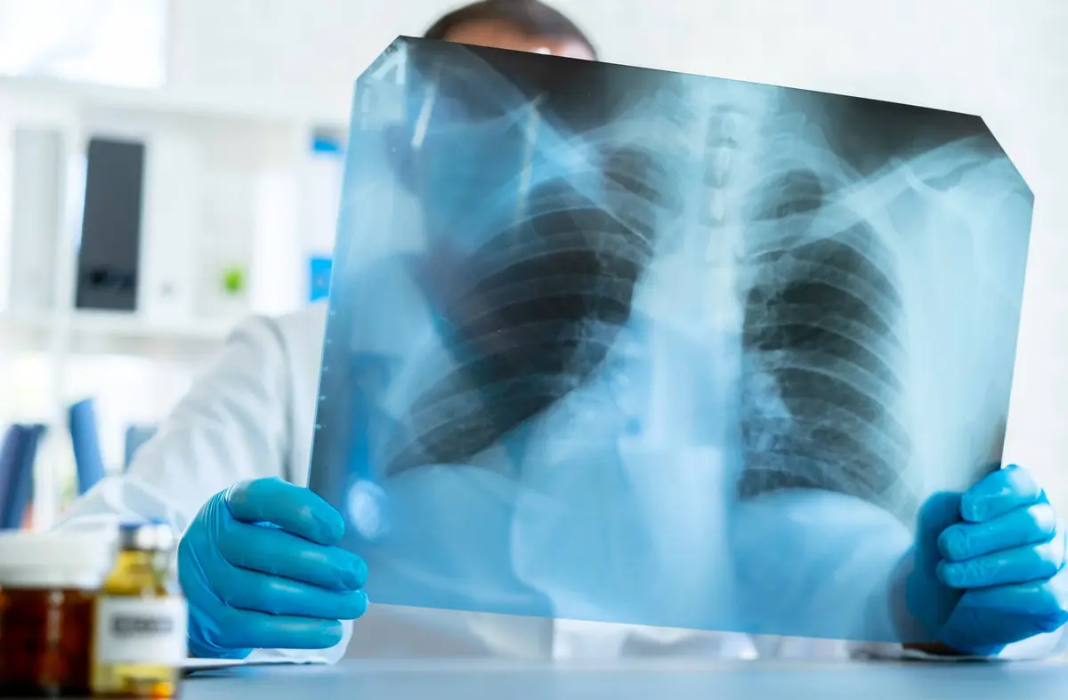 El Hospital Puerta de Hierro Majadahonda participa en uno de los estudios genómicos más amplios realizados en cáncer de pulmón resecable